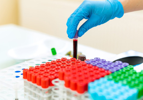 Glycated Hemoglobin Test (HbA1c): What You Need to Know